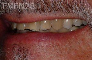 Kurt-Schneider-Dental-Crowns-before-8