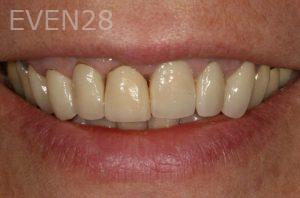 Kurt-Schneider-Dental-Crowns-before-9