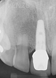 Kurt-Schneider-Dental-Implants-after-2b