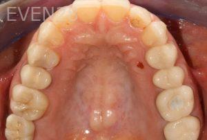 Kurt-Schneider-Dental-Implants-after-4