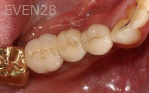 Kurt-Schneider-Dental-Implants-after-5