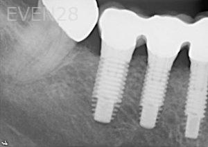 Kurt-Schneider-Dental-Implants-after-5b