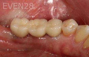 Kurt-Schneider-Dental-Implants-after-7