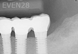 Kurt-Schneider-Dental-Implants-after-7b