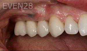 Kurt-Schneider-Dental-Implants-after-8