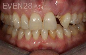 Kurt-Schneider-Dental-Implants-before-1