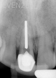 Kurt-Schneider-Dental-Implants-before-2bKurt-Schneider-Dental-Implants-before-2b