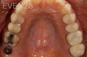 Kurt-Schneider-Dental-Implants-before-4