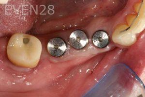Kurt-Schneider-Dental-Implants-before-5