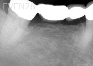 Kurt-Schneider-Dental-Implants-before-5b