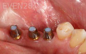 Kurt-Schneider-Dental-Implants-before-7