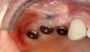 Kurt-Schneider-Dental-Implants-before-8