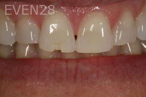 Kurt-Schneider-Dental-bonding-before-4