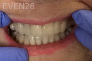 Lamise-Kassem-Dental-Bonding-after-1