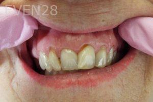 Lamise-Kassem-Dental-Bonding-before-1