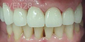 Lamise-Kassem-Dental-Crown-after-1