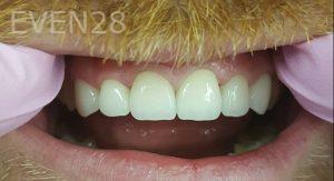 Lamise-Kassem-Dental-Crown-after-10