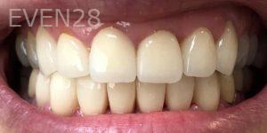 Lamise-Kassem-Dental-Crown-after-2