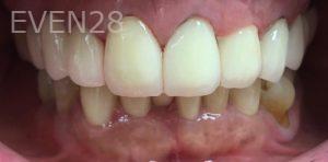 Lamise-Kassem-Dental-Crown-after-3