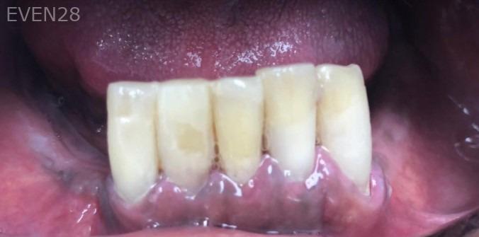 Lamise-Kassem-Dental-Crown-after-5