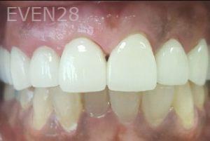 Lamise-Kassem-Dental-Crown-after-7