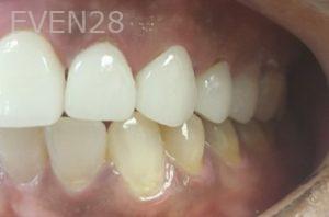Lamise-Kassem-Dental-Crown-after-7b