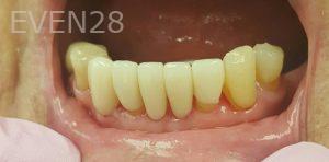 Lamise-Kassem-Dental-Crown-after-9