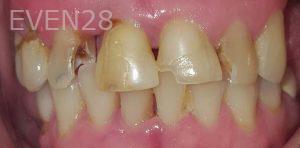 Lamise-Kassem-Dental-Crown-before-1