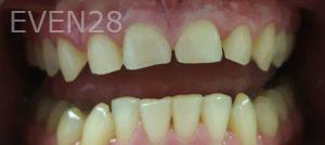 Lamise-Kassem-Dental-Crown-before-10