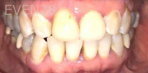 Lamise-Kassem-Dental-Crown-before-2