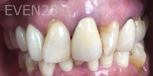 Lamise-Kassem-Dental-Crown-before-3