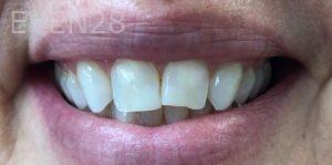 Lamise-Kassem-Dental-Crown-before-4