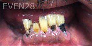 Lamise-Kassem-Dental-Crown-before-5