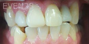 Lamise-Kassem-Dental-Crown-before-6