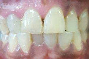 Lamise-Kassem-Dental-Crown-before-7