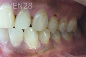 Lamise-Kassem-Dental-Crown-before-7b