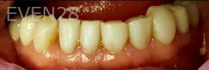 Lamise-Kassem-Dental-Crown-before-8