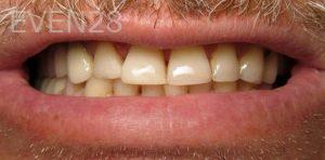 Lile-Bunar-Dental-Bonding-after-1