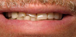 Lile-Bunar-Dental-Bonding-before-1