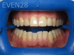 Lile-Bunar-Teeth-Whitening-before-1