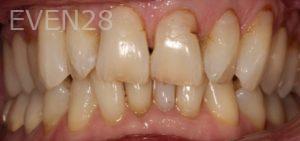 Lilian-Cifarelli-Dental-Bonding-before-1