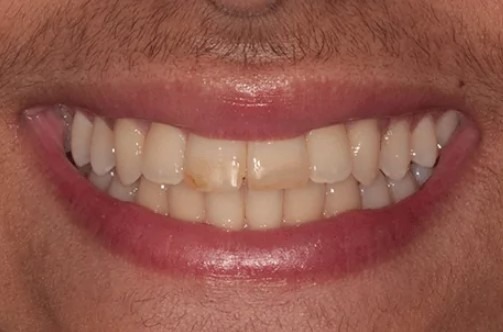 Lincoln-Parker-Dental-Bonding-before-1