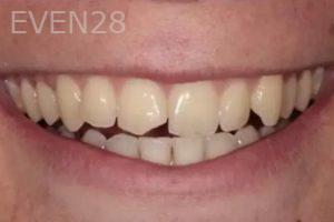 Lincoln-Parker-Dental-Bonding-before-2