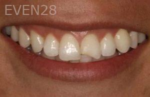 Lincoln-Parker-Dental-Bonding-before-3