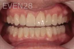 Lincoln-Parker-Dental-Crowns-after-1b