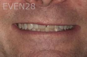 Lincoln-Parker-Dental-Crowns-before-1