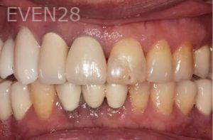 Lincoln-Parker-Dental-Crowns-before-10
