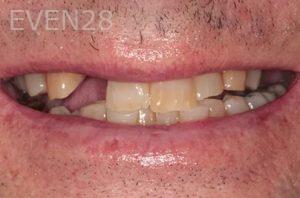 Lincoln-Parker-Dental-Crowns-before-11