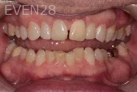 Lincoln-Parker-Dental-Crowns-before-1b