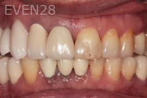 Lincoln-Parker-Dental-Crowns-before-3